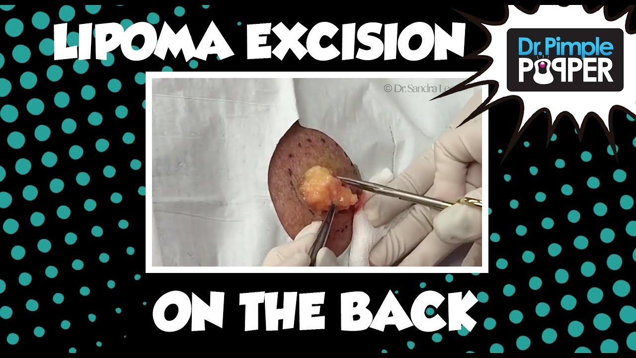 Lipoma excision, Upper Back