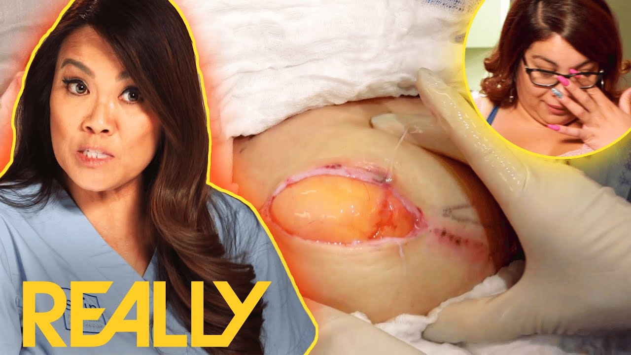 Lipoma Is So Big It Looks Like A Third Breast | Dr. Pimple Popper