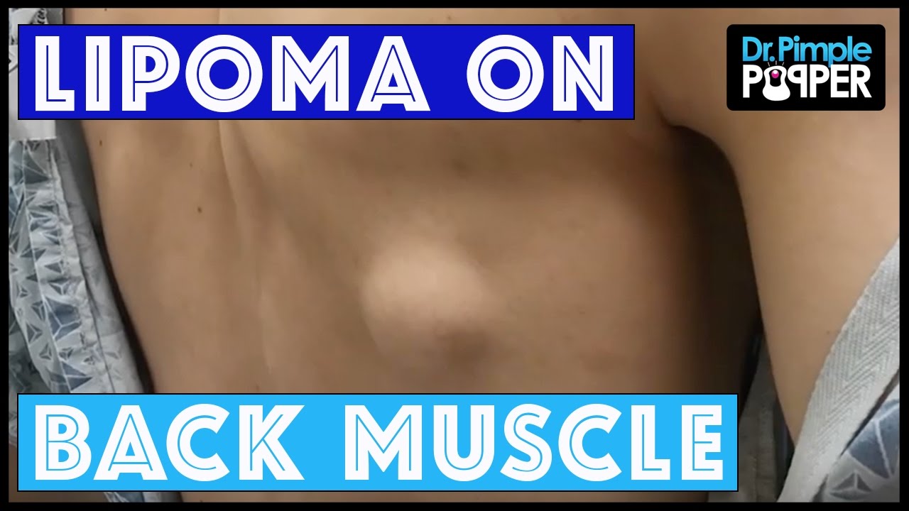 Lipoma on the back muscle