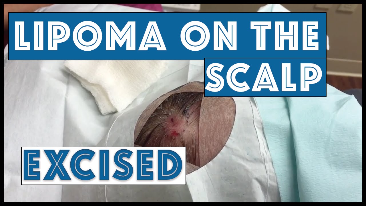 Lipoma on the scalp excised