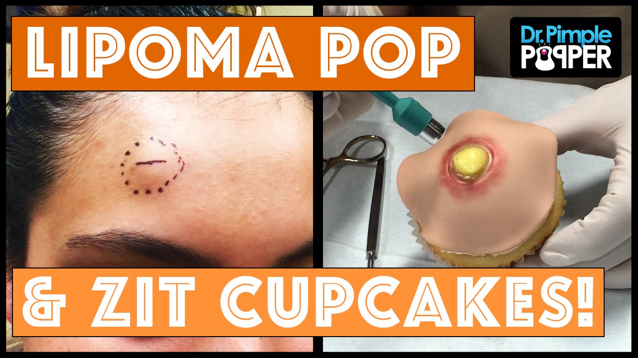 Lipoma Pop & Zit Cupcakes!