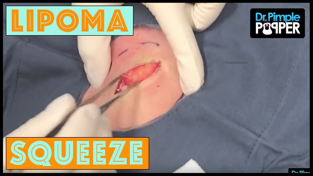 Lipoma Squeeze in a Nervous Patient