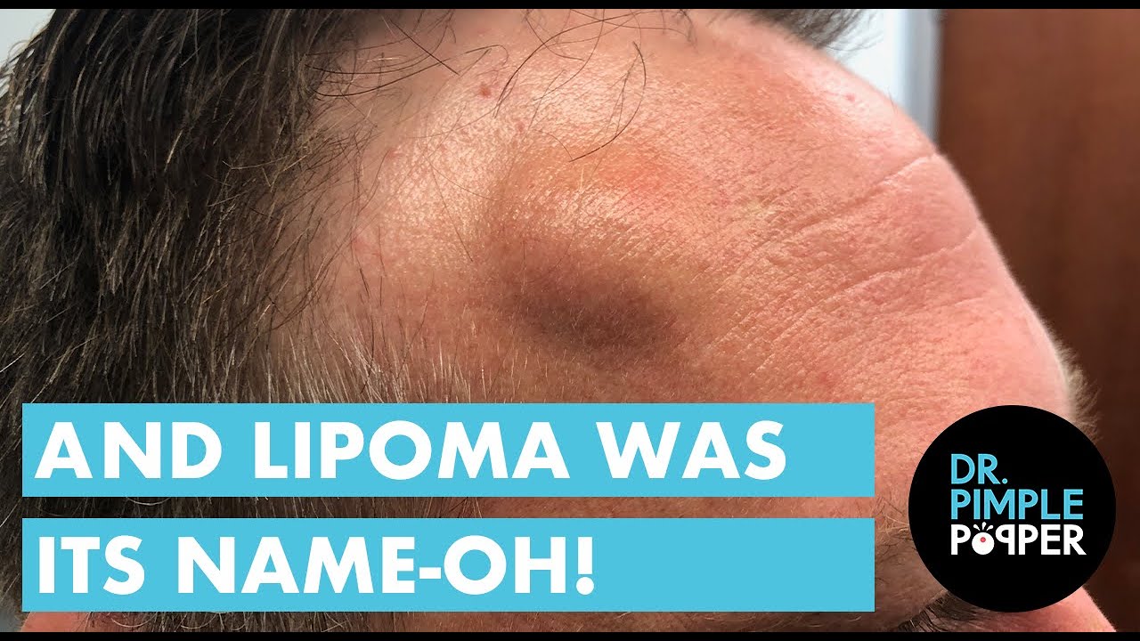 Lipoma Was It's Name-Oh!