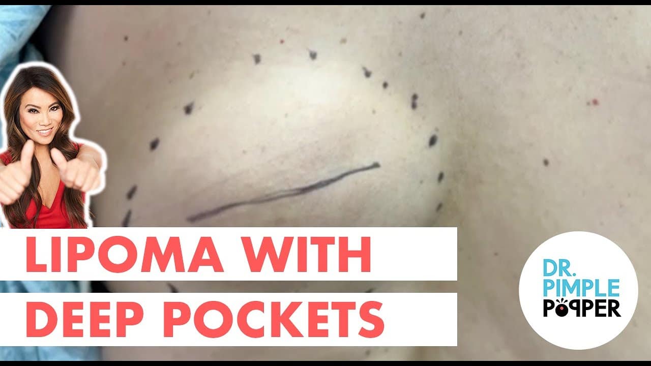 Lipoma with Deep Pockets