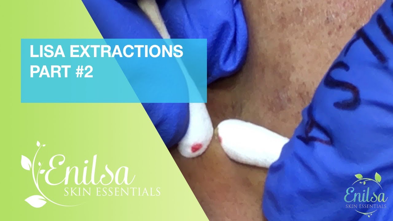 Lisa Extractions Part 2
