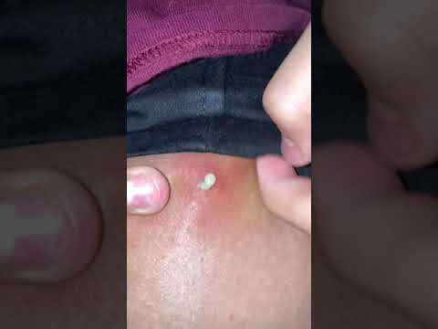 Little cyst popped ??