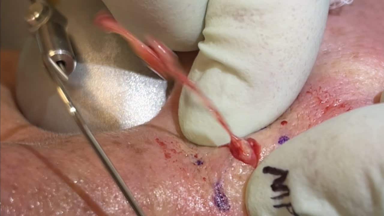 Little popper show stopper cyst. Inflamed cyst in between the eyes that packs quite a pop. I+D