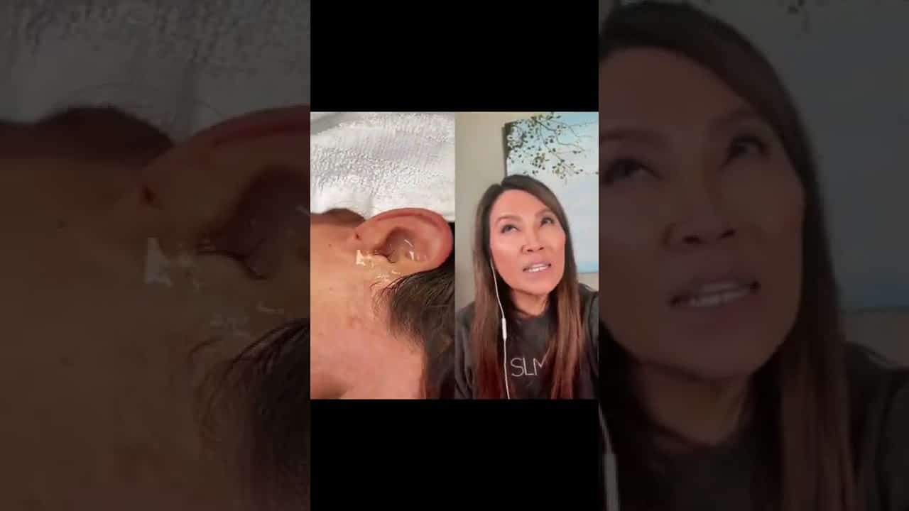 Live Insect In Ear! Dr Pimple Popper Reacts