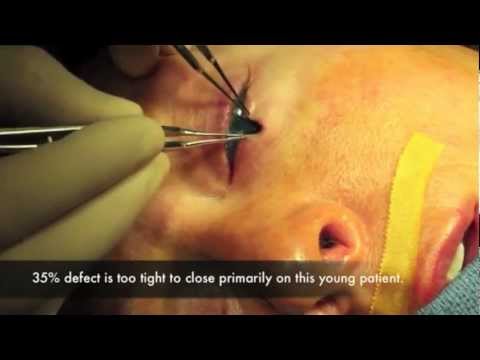 Live Surgery Lower eyelid reconstruction surgery following skin cancer.m4v