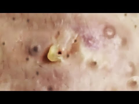 Lovely Open & Closed Blackheads Removal – The best Pimple Popping Videos