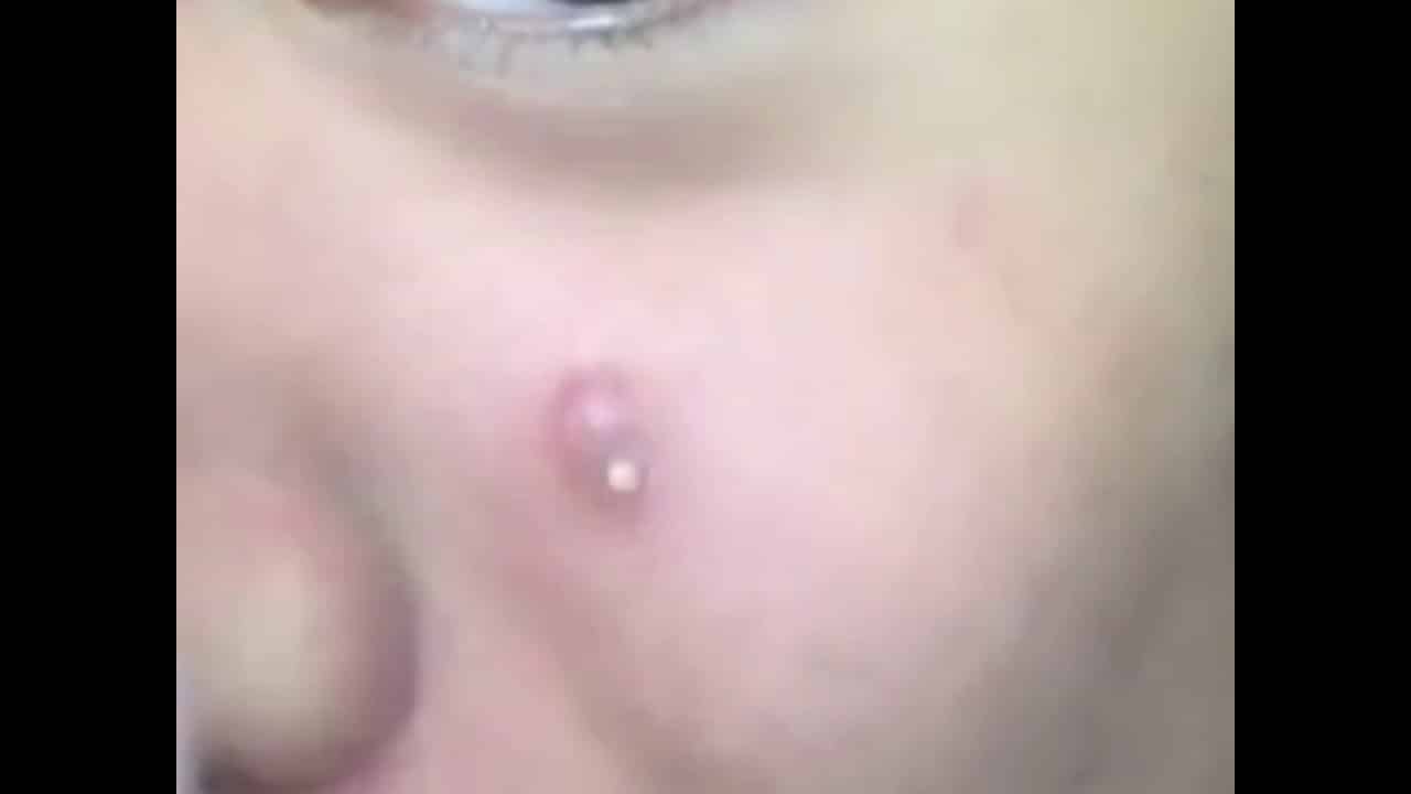 Lovely pimple popping EP2