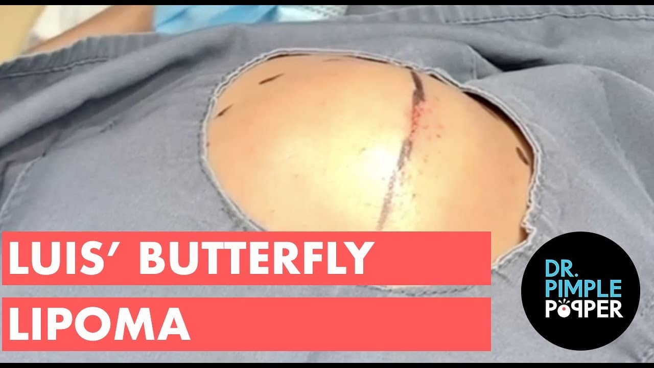 Luis’ Butterfly Lipoma