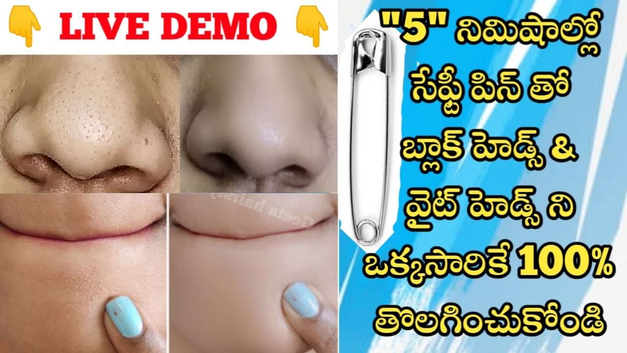 Magical😍 Remedy Just 5 Mins 😱 Remove Blackheads & White heads At Naturally In తెలుగు || 💯% Work 👍🏻👍🏻