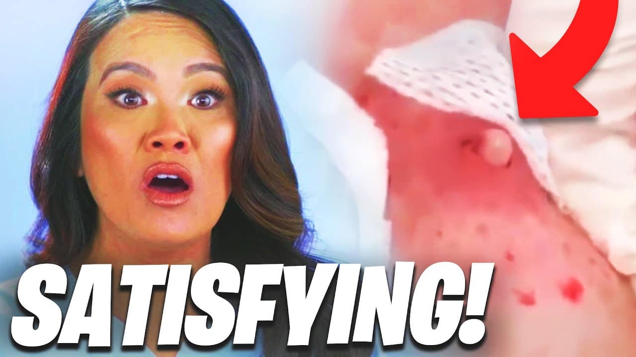 Major Satisfying Pimple Popping Moments 2021! (Part 4)