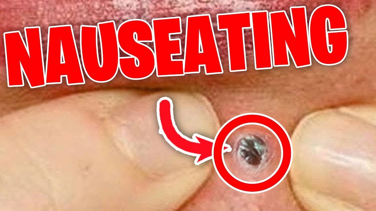 Major satisfying Pimple Popping moments 2021 – Part 13