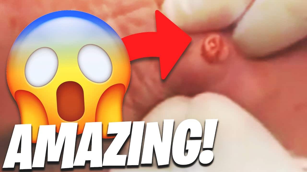 Major SATISFYING Pimple Popping Moments 2021! (Part 7)