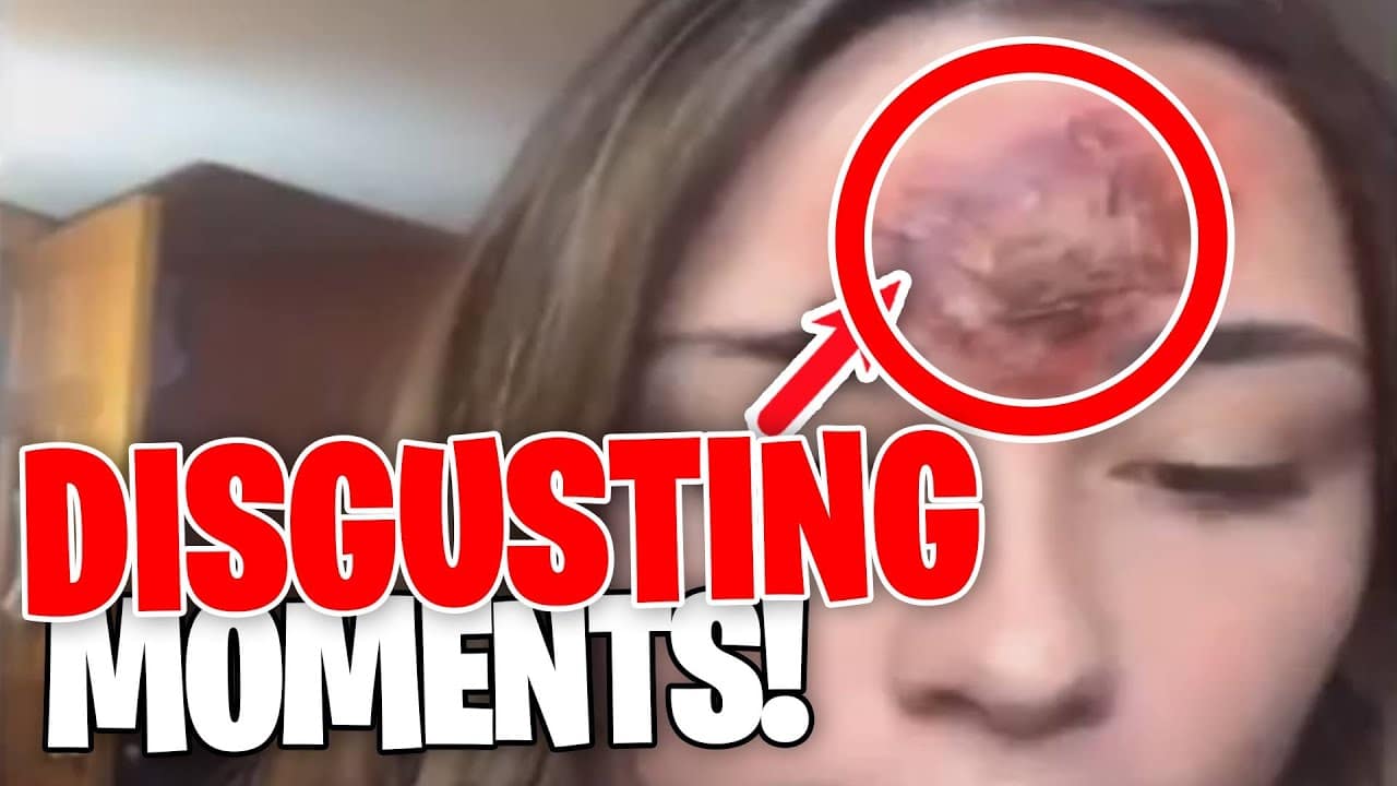 MAJORLY DISGUSTING Pimple Popping Moments from 2021! (PART 2)
