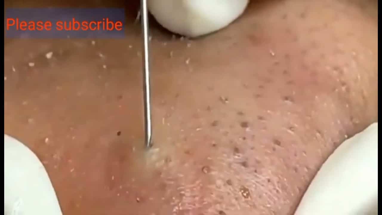 Makes your day relaxing with  Spa, nose blackheads removal