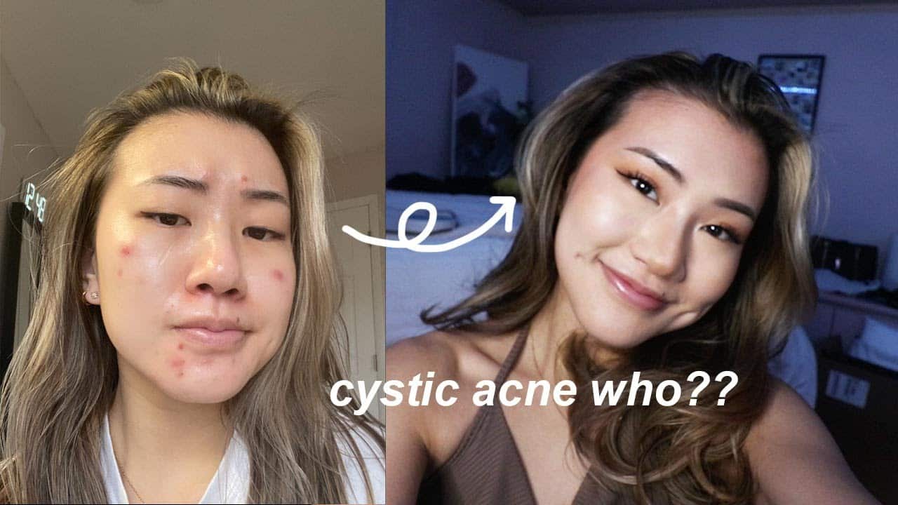 makeup for cystic acne | daily makeup routine [monolid friendly!]