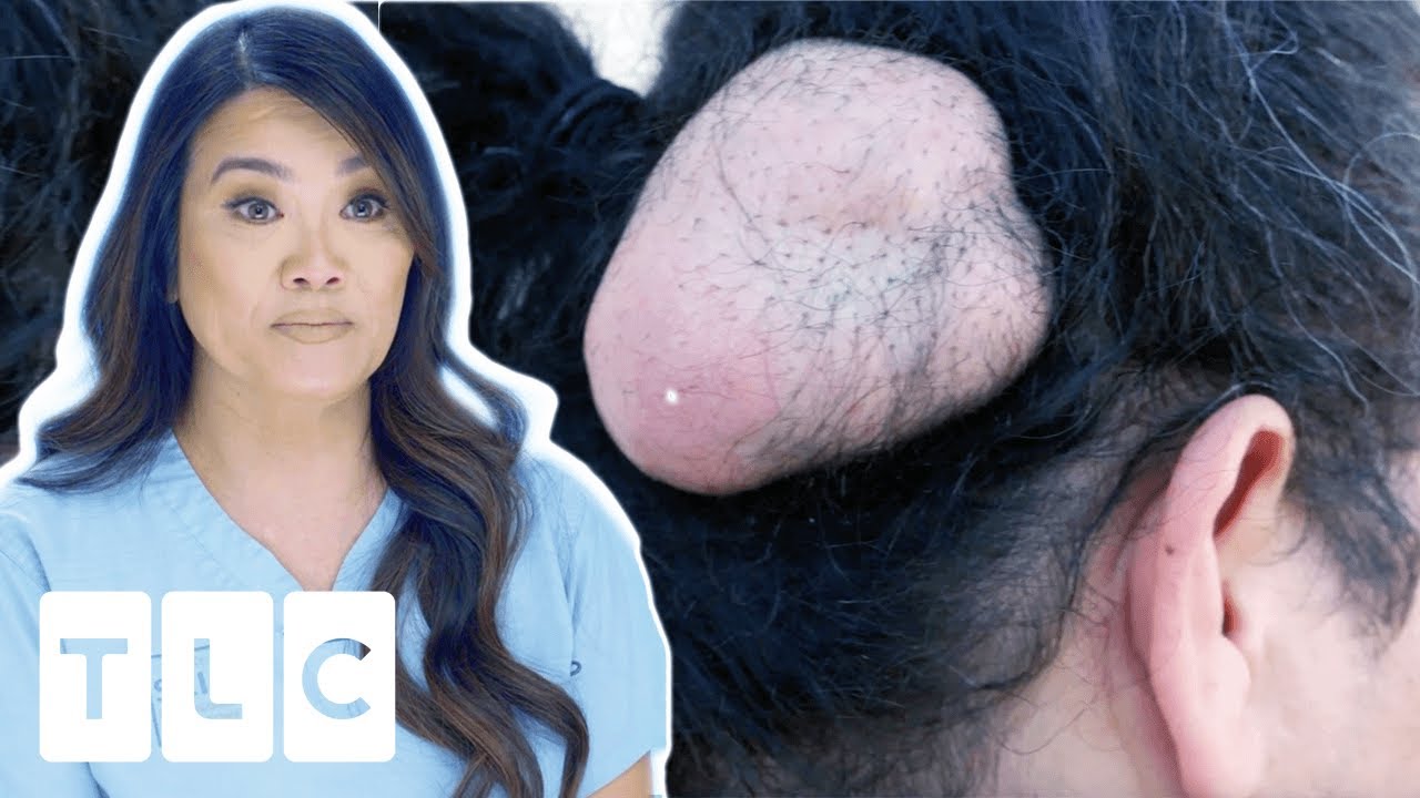 Man Overcomes Fear Of Doctors To Have Big Lump Removed I Dr. Pimple Popper