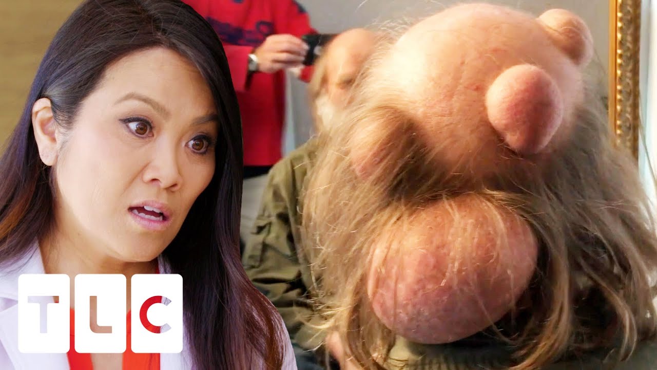 Man Probably Has The Biggest Pilar Cyst Dr Lee Has Ever Seen | Dr. Pimple Popper: Before The Pop