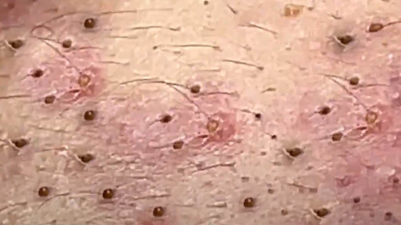 Many Huge Blackheads Goldmine On Nose,pimple popping videos new youtube 2020