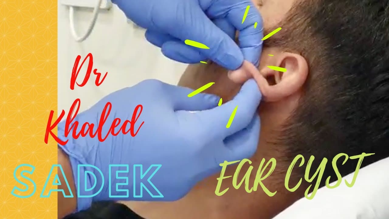 Massive 15 yr Ear Cyst. Dr Khaled Sadek. Lipomacyst.com