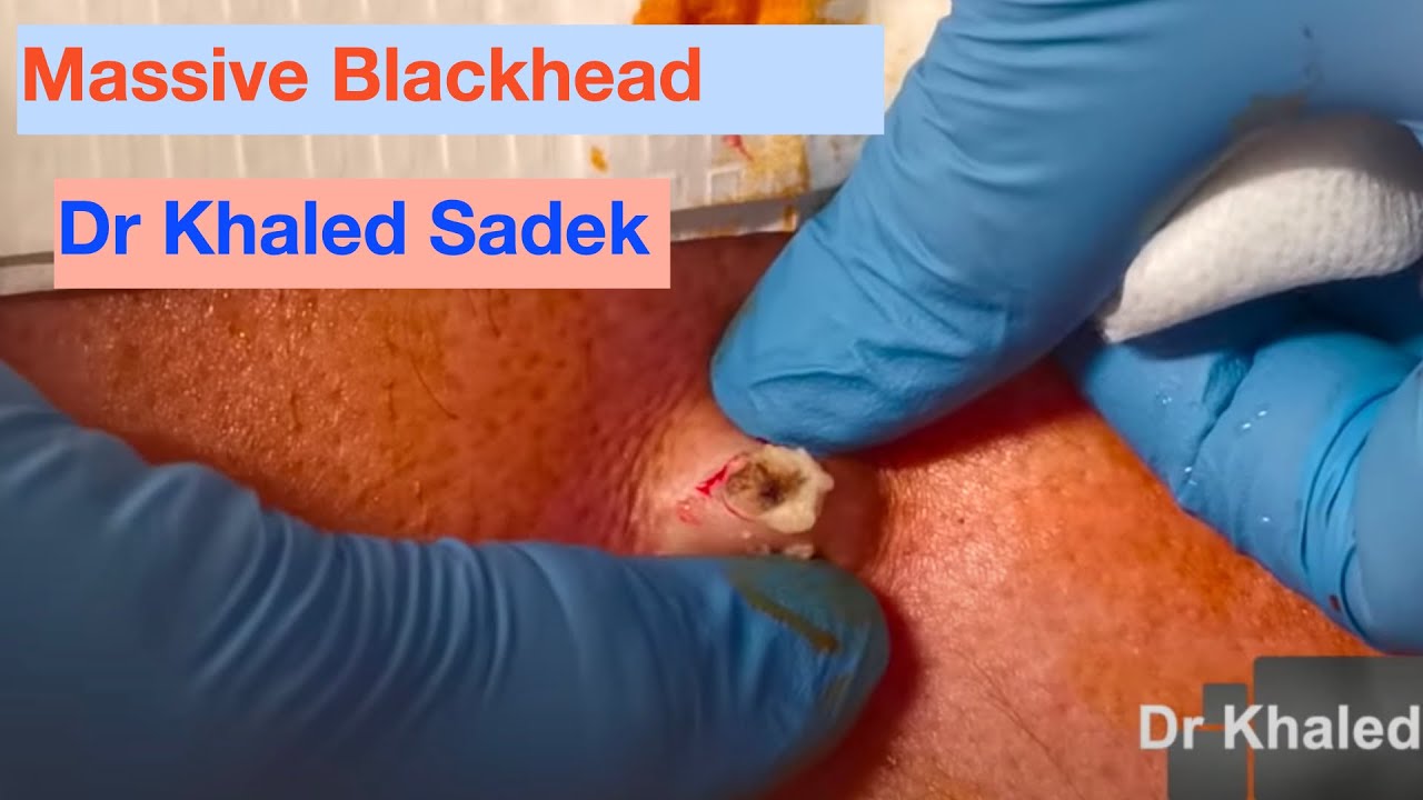 Massive Blackhead Removed. Dr Khaled Sadek. London Cyst Clinic