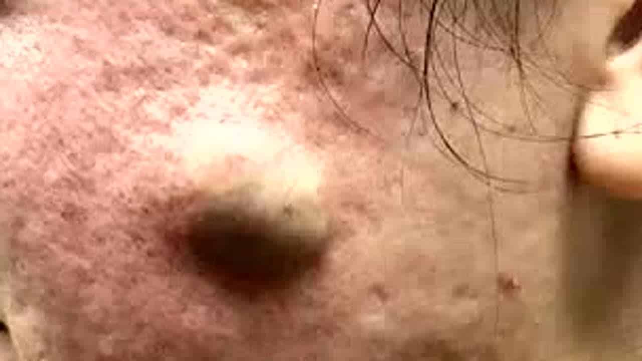 Massive Blackheads Cyst Removed From Scalp, Pimple Popping #01