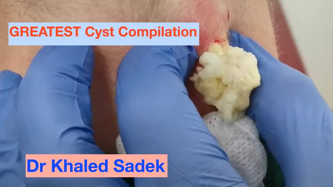 Massive Cyst Compilation. Dr Khaled Sadek. London Cyst Clinic