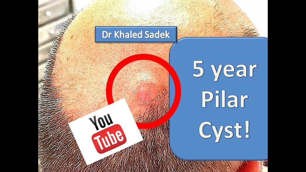 Massive Cyst. Dr Khaled Sadek. London Cyst Clinic