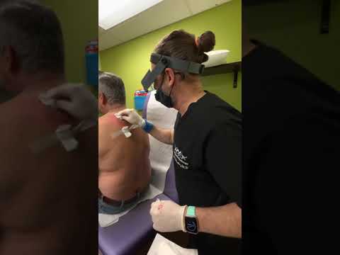 Massive Cyst Incision & Drainage at Las Vegas Dermatology by Dr. H.L. Greenberg