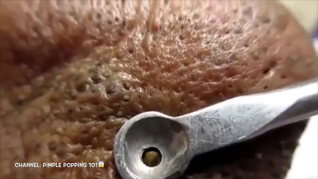 Massive cyst & large blackheads Lots of pus compilation