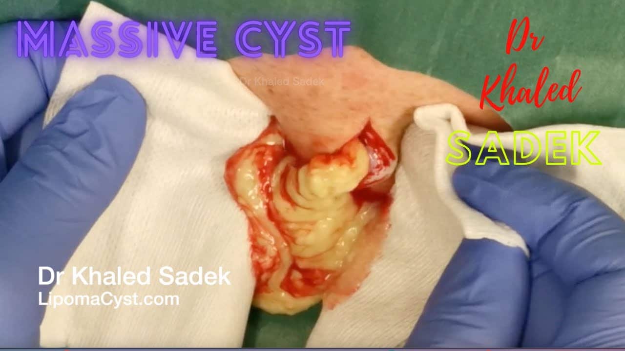 Massive Cyst Removal. Dr Khaled Sadek. LipomaCyst.com