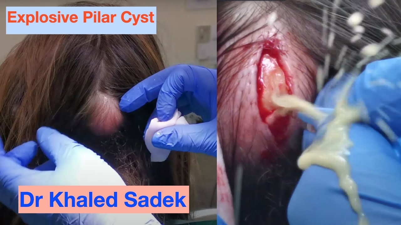 MASSIVE EXPLODING PILAR CYST. Dr Khaled Sadek. LipomaCyst.com