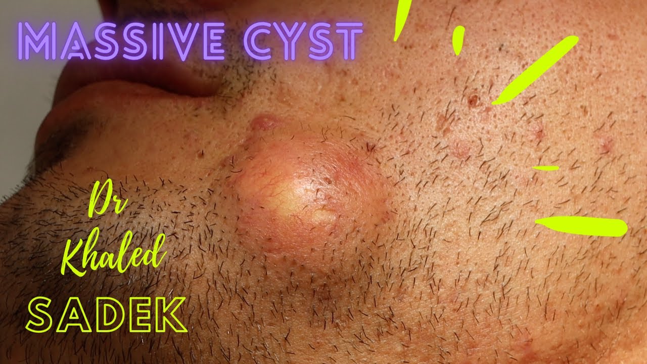 Massive Face Cyst. Dr Khaled Sadek. LipomaCyst.com