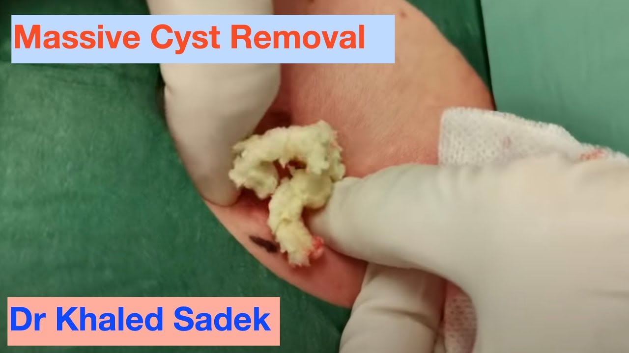 Massive Pimple Explosion. Cyst Removal Clinic London