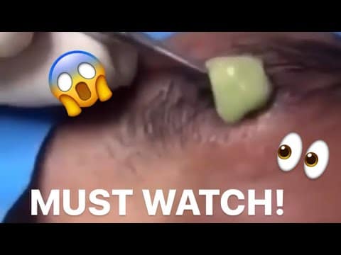 Massive Pimple Popped on EyeBrow | Pimple Popping | WeViralNow