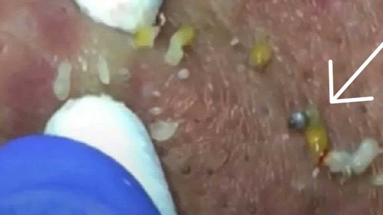 MASSIVE PIMPLE POPPING Satisfying Videos With LikeU Care