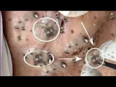 MASSIVE PIMPLE POPPING Satisfying Videos With Vieng Spa #118