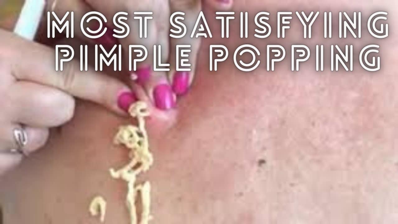 MASSIVE PIMPLE POPPING Satisfying Videos COMPILATION | Worlds Biggest Pimple Pops | Pimple Popping