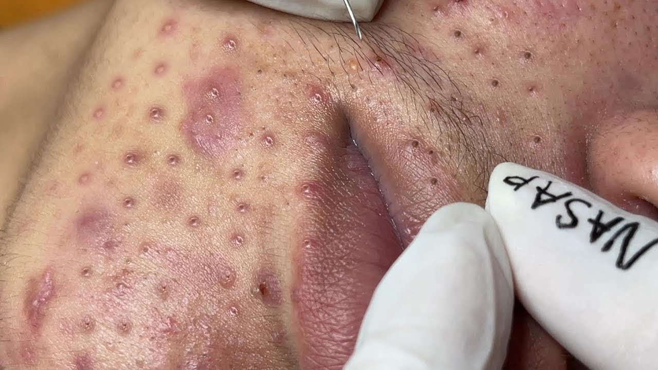 MASSIVE PIMPLE POPPING Satisfying Videos with  Vieng Spa