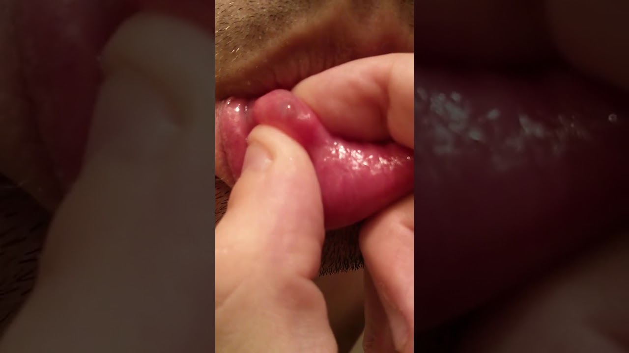 (Medicalpages.info) Huge Lip Pimple !! Popping pimple Youtube video 2017