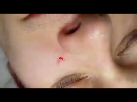 (Medicalpages.info)Pimples Popping Compilation: Flying Pimples, Huge Nasty Cysts