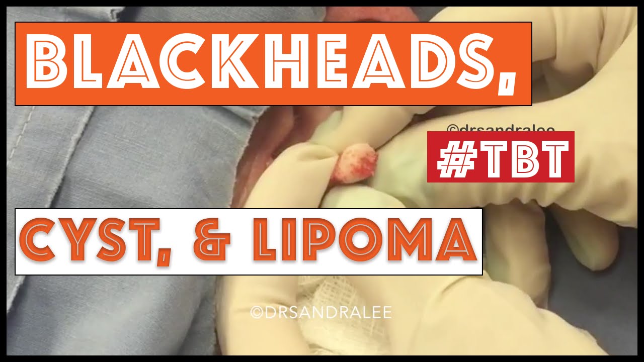 Medley with updates: Blackheads, cyst, lipoma – #TBT