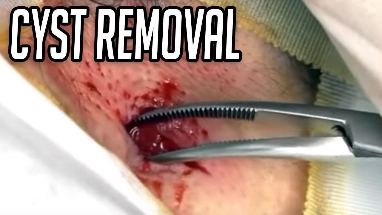 Messy Cyst Removal!  Just the Pop!  Dr. John Gilmore