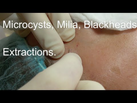 Microcysts, Milia, and Blackheads Extractions