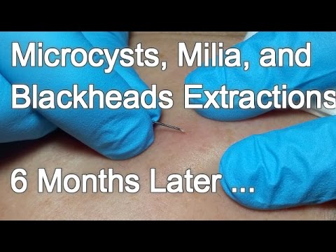 Microcysts, Milia, and Blackheads Extractions –  6 MONTHS LATER