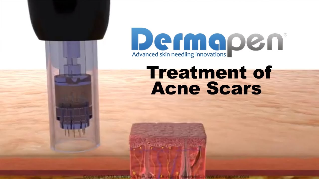 MicroNeedling for Acne Scars – Dermapen® Treatment