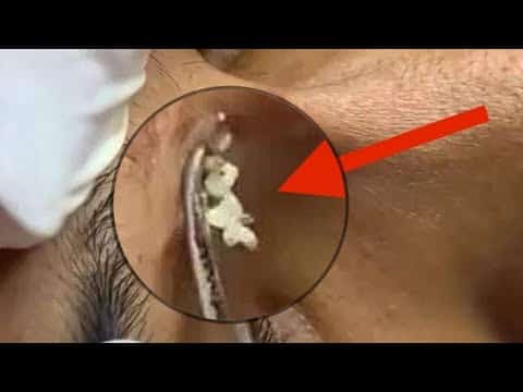 Milia and pimple popping cyst Part 12
